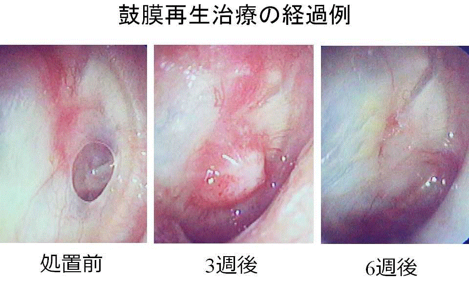 滲出 性 オファー 中耳炎 イヤホン